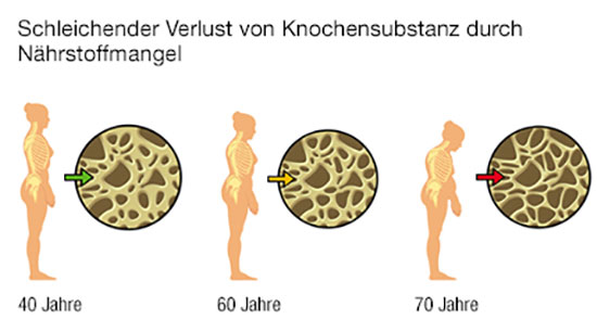 Dem Knochenabbau vorbauen